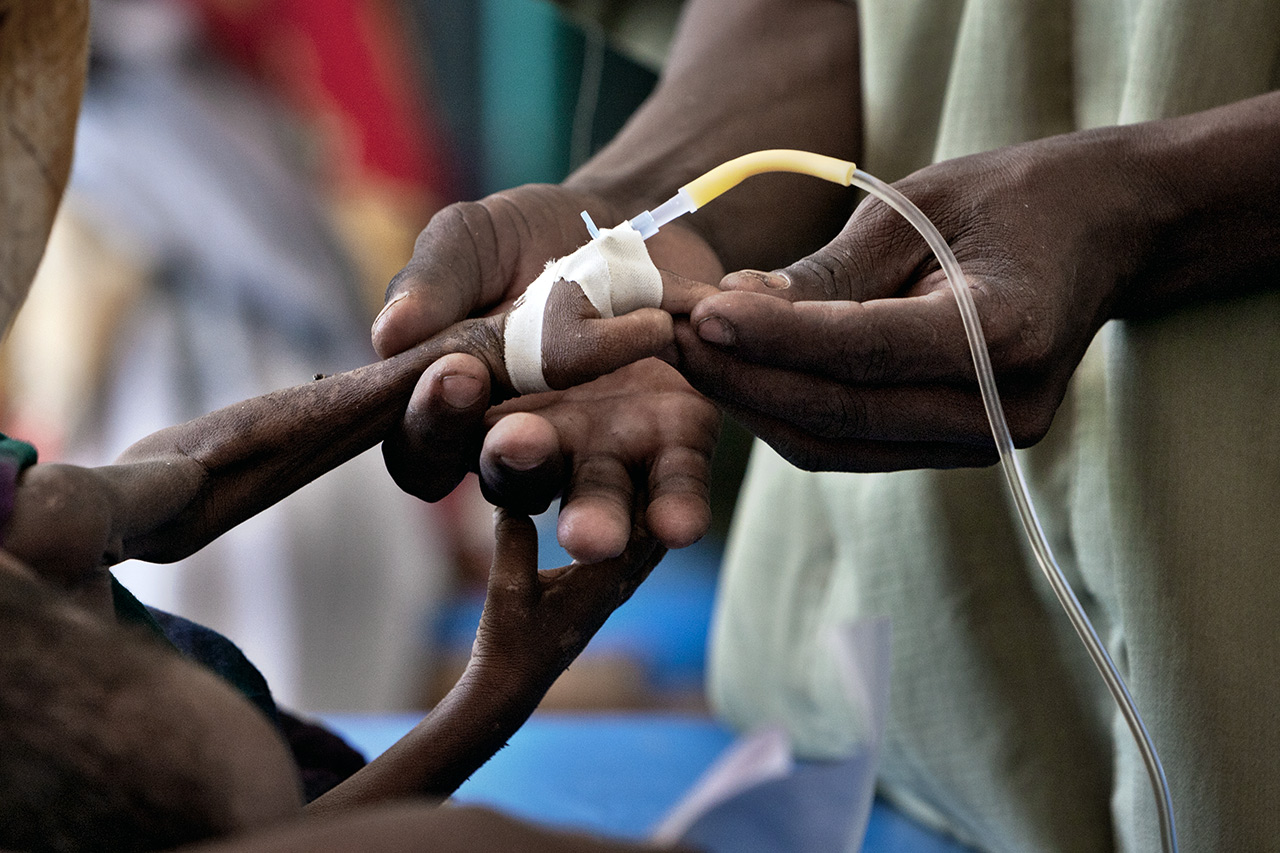 Consequences of the drought in Somalia: this refugee child suffers from diarrhea. Photo: Christoph Püschner/Der Spiegel